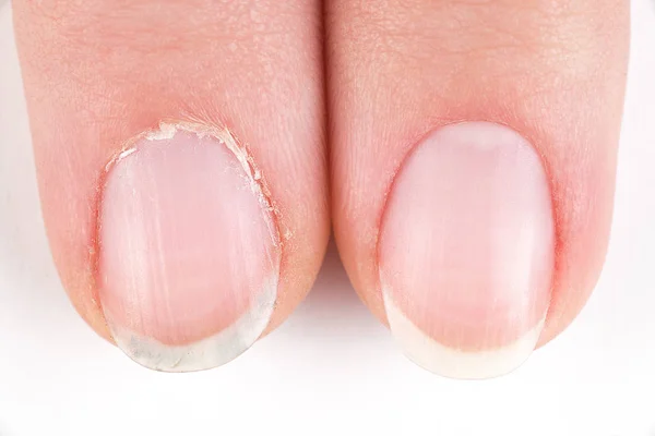 Comparison of the beautiful and the ugly manicure — Stock Photo, Image