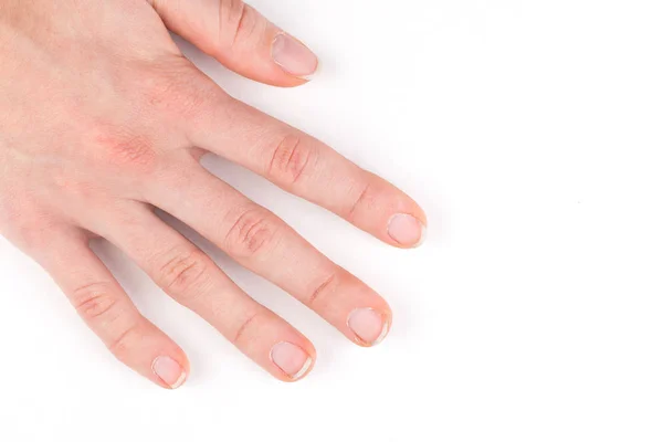 Γυναικείο χέρι με άσχημο μανικιούρ — Φωτογραφία Αρχείου