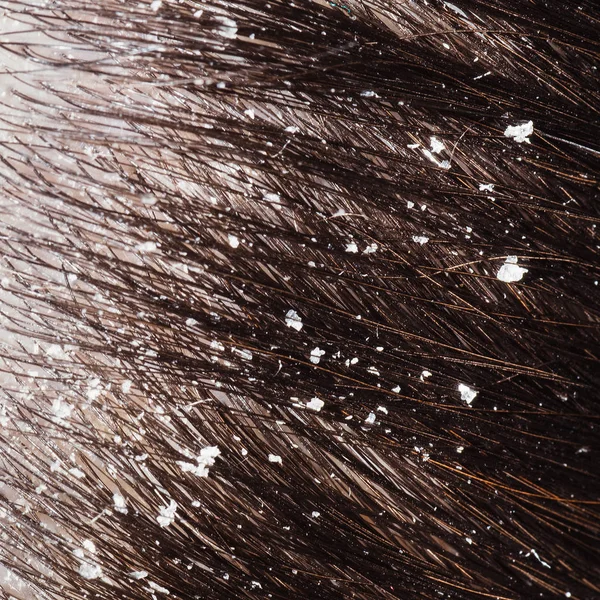 Dandruff on woman's dark hair — Stock Photo, Image