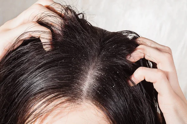 Dander that causes itching scalp — Stock Photo, Image