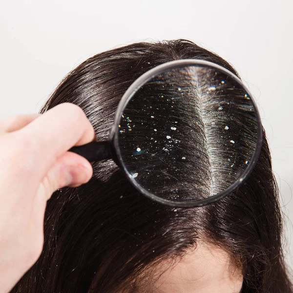 The doctor looks through a magnifying glass at the dandruff on d — Stock Photo, Image