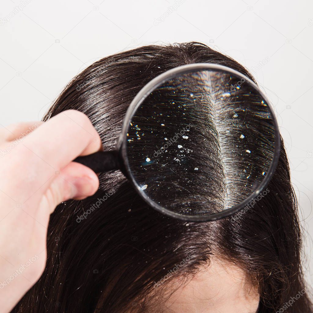 The doctor looks through a magnifying glass at the dandruff on d