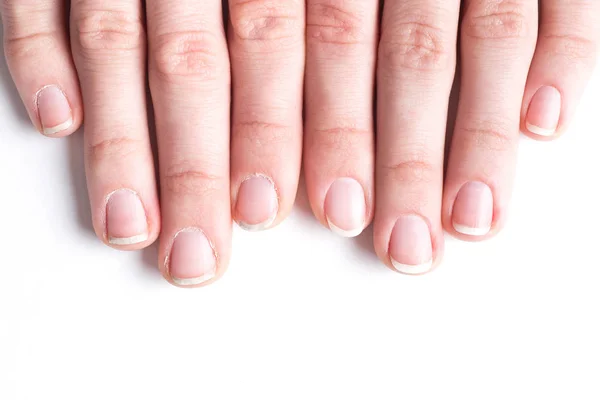 Comparison of the beautiful and the ugly manicure — Stock Photo, Image