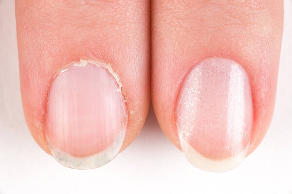 Comparison of the beautiful and the ugly manicure