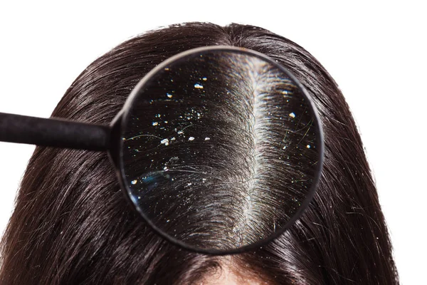 The doctor looks through a magnifying glass at the dandruff on d — Stock Photo, Image
