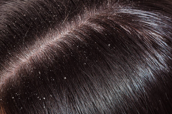 Перхоть на темных волосах женщины
 