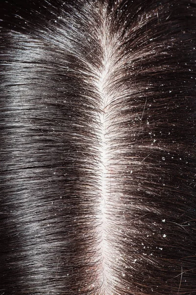 Caspa en el cabello oscuro de la mujer — Foto de Stock