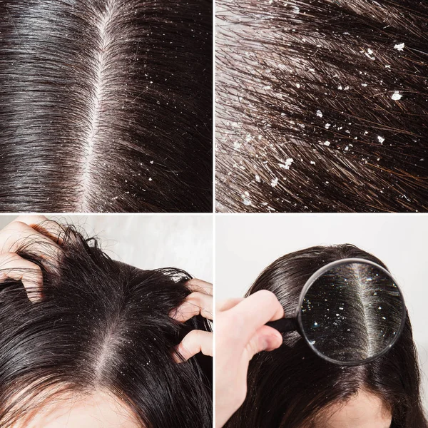 Korpásodás a Sötét haja — Stock Fotó