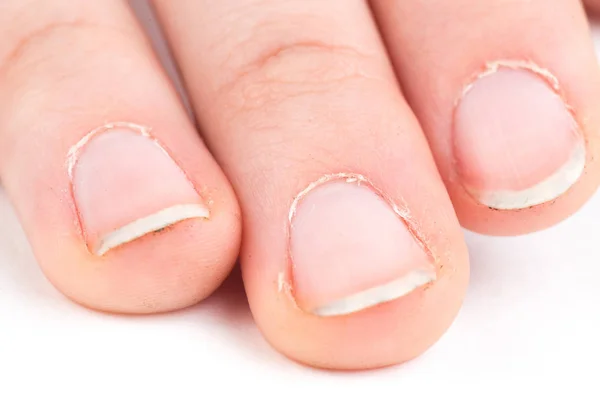 Ręka z manicure brzydkie — Zdjęcie stockowe