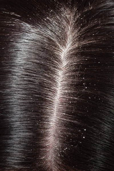 Πιτυρίδα σε σκούρα μαλλιά της γυναίκας — Φωτογραφία Αρχείου