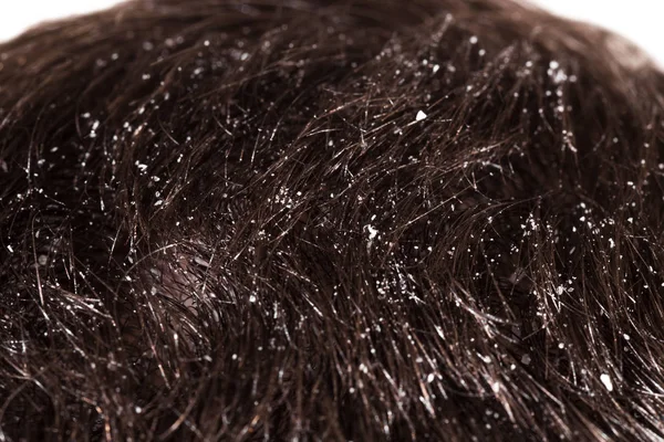 Dandruff on male dark hair — Stock Photo, Image