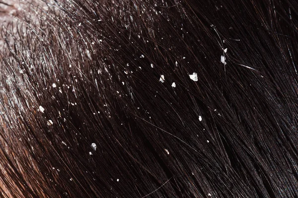 Dandruff on woman's dark hair — Stock Photo, Image