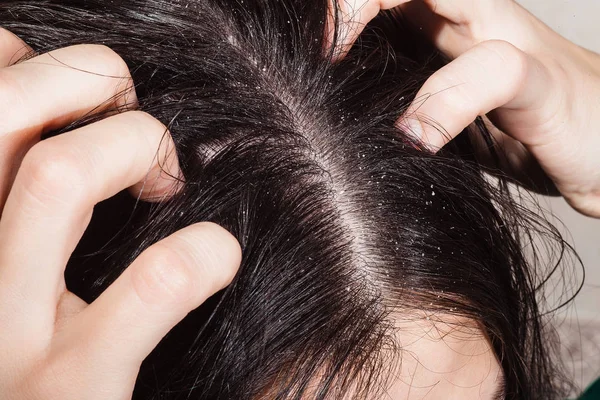 Caspa que causa picazón en el cuero cabelludo —  Fotos de Stock