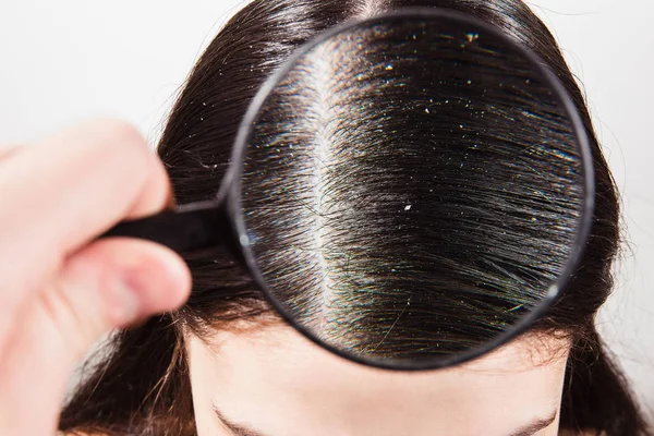 The doctor looks through a magnifying glass at the dandruff on d — Stock Photo, Image