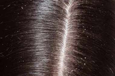 Kepek kadın siyah saçlı üzerinde 