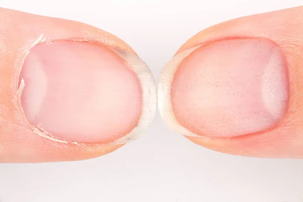 Comparison of the beautiful and the ugly manicure — Stock Photo, Image