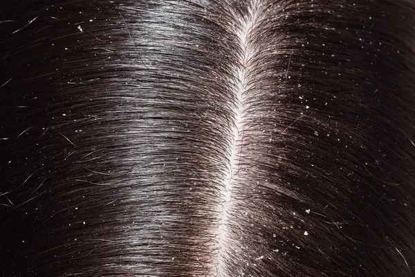 Dandruff on woman's dark hair — Stock Photo, Image