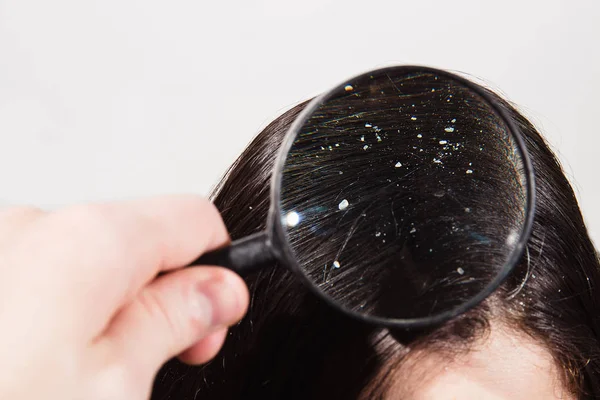 The doctor looks through a magnifying glass at the dandruff on d — Stock Photo, Image