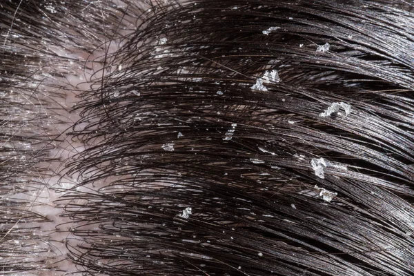 Dandruff on her dark hair — Stock Photo, Image