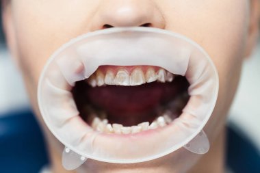 Kadın beyaz diş Retraktörü içinde ile ön görünüm Close-Up 