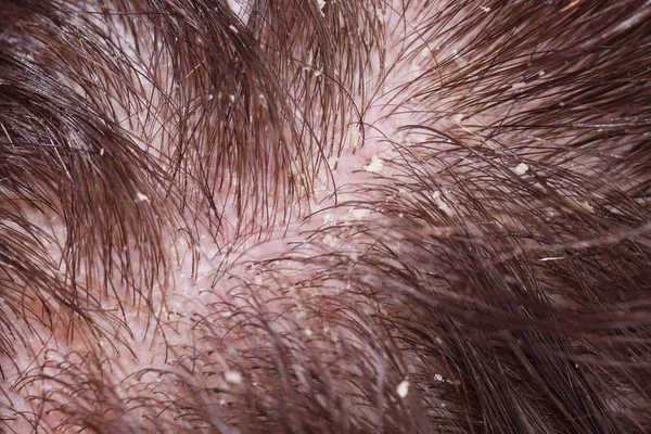 Caspa en cabello oscuro masculino —  Fotos de Stock