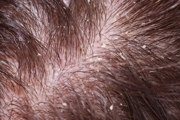 Dandruff on male dark hair — Stock Photo, Image