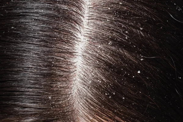 Dandruff on woman's dark hair — Stock Photo, Image