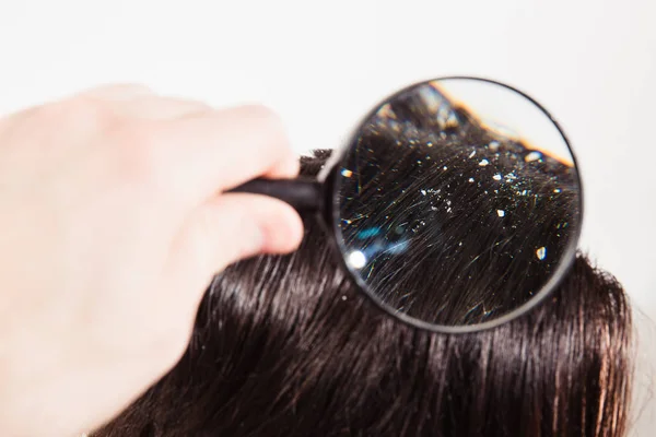 The doctor looks through a magnifying glass at the dandruff on d — Stock Photo, Image