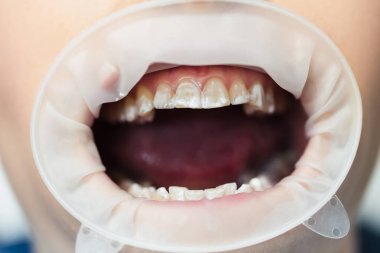 Kadın beyaz diş Retraktörü içinde ile ön görünüm Close-Up 