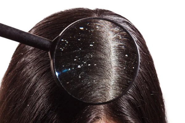 The doctor looks through a magnifying glass at the dandruff on d — Stock Photo, Image