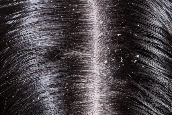 Caspa en el cabello oscuro de la mujer — Foto de Stock