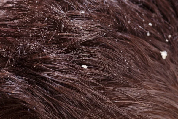 Dandruff on male dark hair — Stock Photo, Image