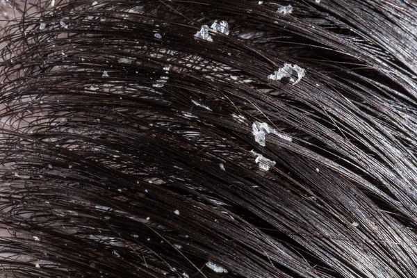 Dandruff pada rambut hitam wanita — Stok Foto