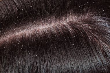 Kepek kadın siyah saçlı üzerinde 