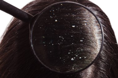 Büyüteç kepek d üzerinde doktor bakar