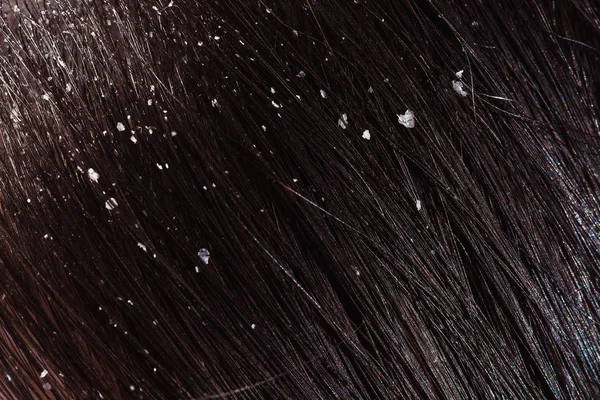 Dandruff on woman's dark hair — Stock Photo, Image