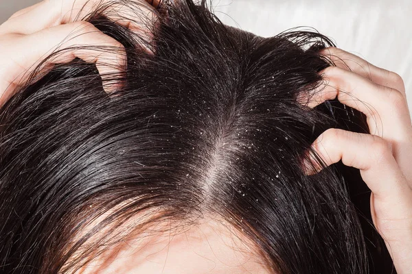 Caspa que causa picazón en el cuero cabelludo —  Fotos de Stock