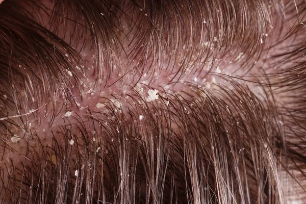 Dandruff on male dark hair — Stock Photo, Image