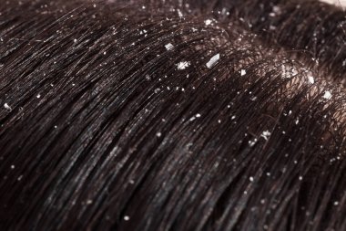 Kepek kadın siyah saçlı üzerinde 