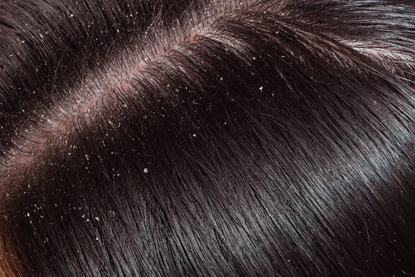 Caspa no cabelo escuro da mulher — Fotografia de Stock