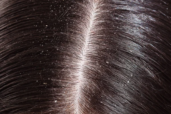 Dandruff on woman's dark hair — Stock Photo, Image