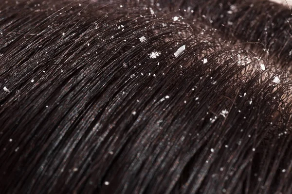 Mjäll på kvinnas mörka hår — Stockfoto