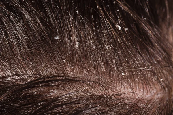 Πιτυρίδα σε αρσενικό σκούρα μαλλιά — Φωτογραφία Αρχείου