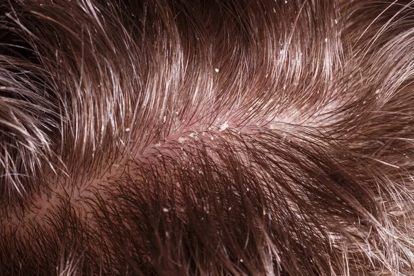 Disease Scalp — Stock Photo, Image