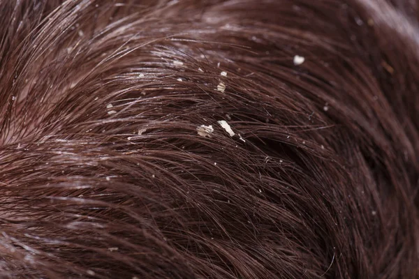 Disease Scalp — Stock Photo, Image