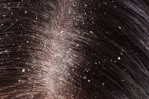 Problema Del Cuoio Capelluto Secco Sui Capelli Scuri — Foto Stock