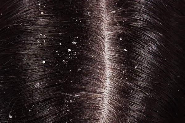 Problem Dry Scalp Dark Hair — Stock Photo, Image
