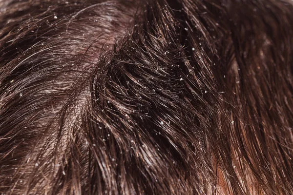Πρόβλημα Του Ξηρού Τριχωτού Της Κεφαλής Σκούρα Μαλλιά — Φωτογραφία Αρχείου