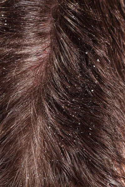 黑发干性头皮问题 — 图库照片