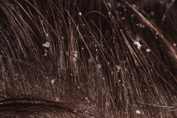 Koyu saçlı kuru kafa derisi sorunu.